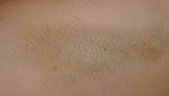 Liječenje hiperhidroze botox-om